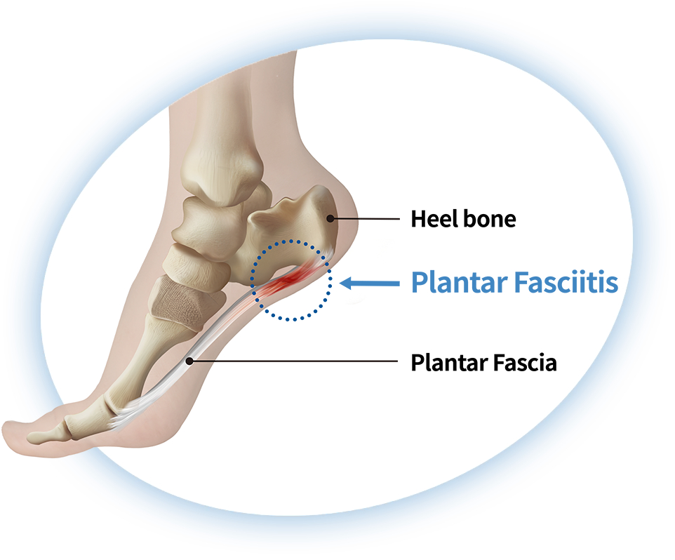Endoscopic Plantar Fascia can