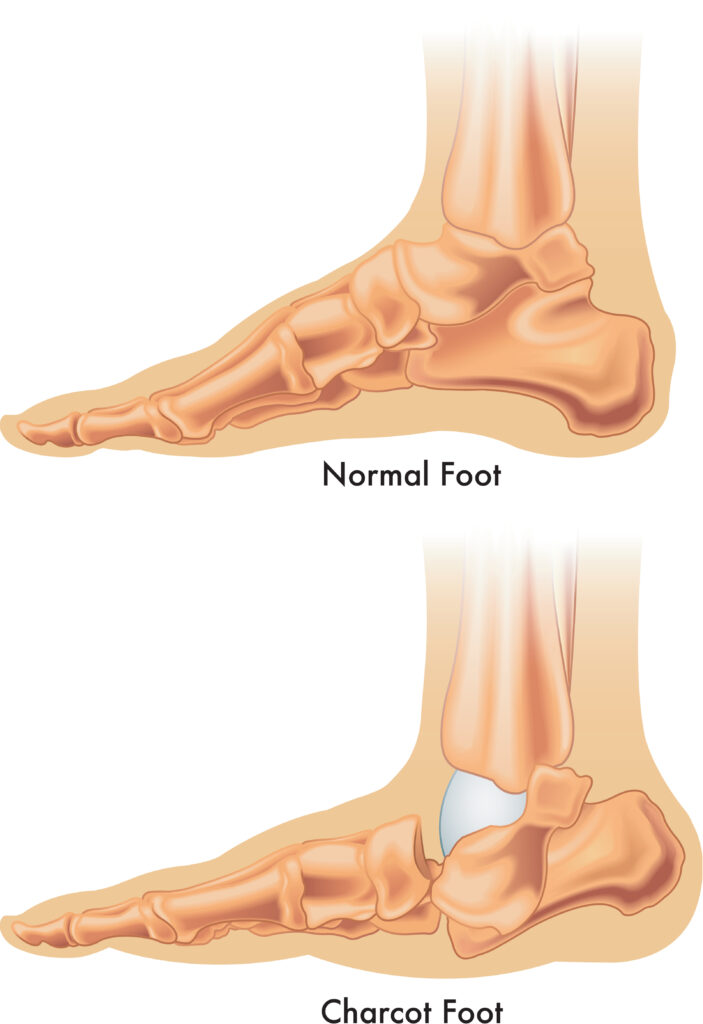 A diagram of a regular foot compared to Charcot Foot.